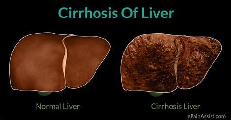 Cirrhosis